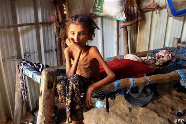 الإغاثة الإسلامية: معدلات سوء التغذية في اليمن تعد من أعلى المعدلات على الإطلاق